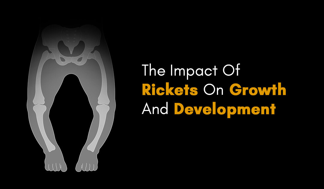 The Impact Of Rickets On Growth And Development